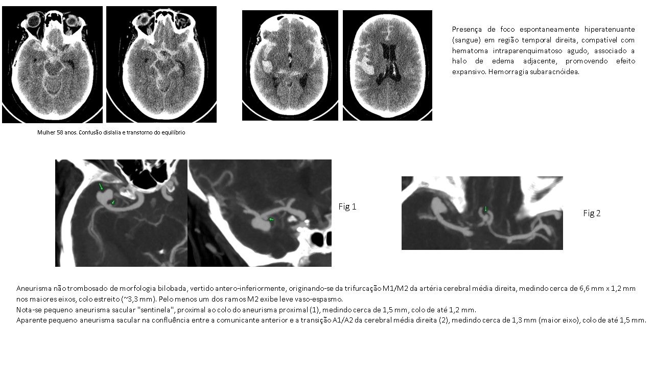 Aneurisma Cerebral