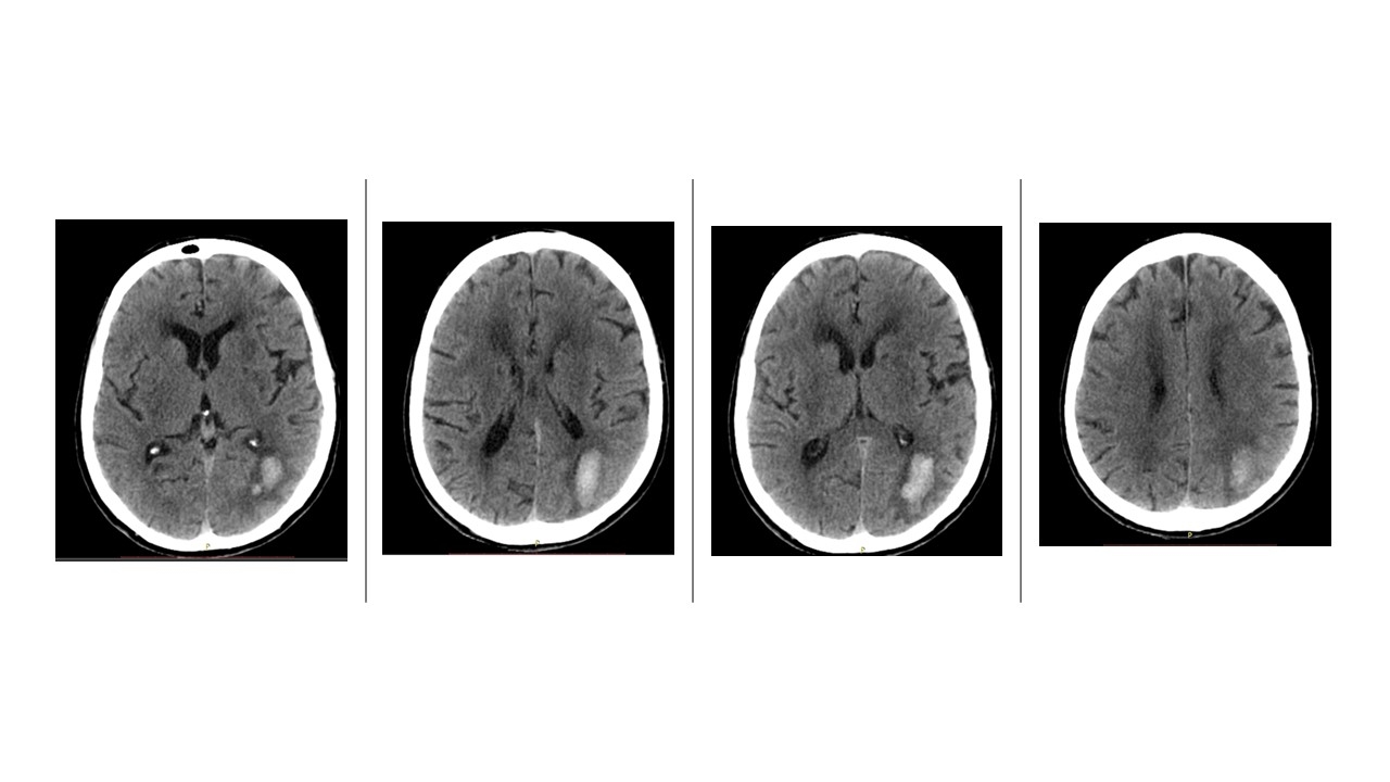 Angiopatia Amiloide Cerebral