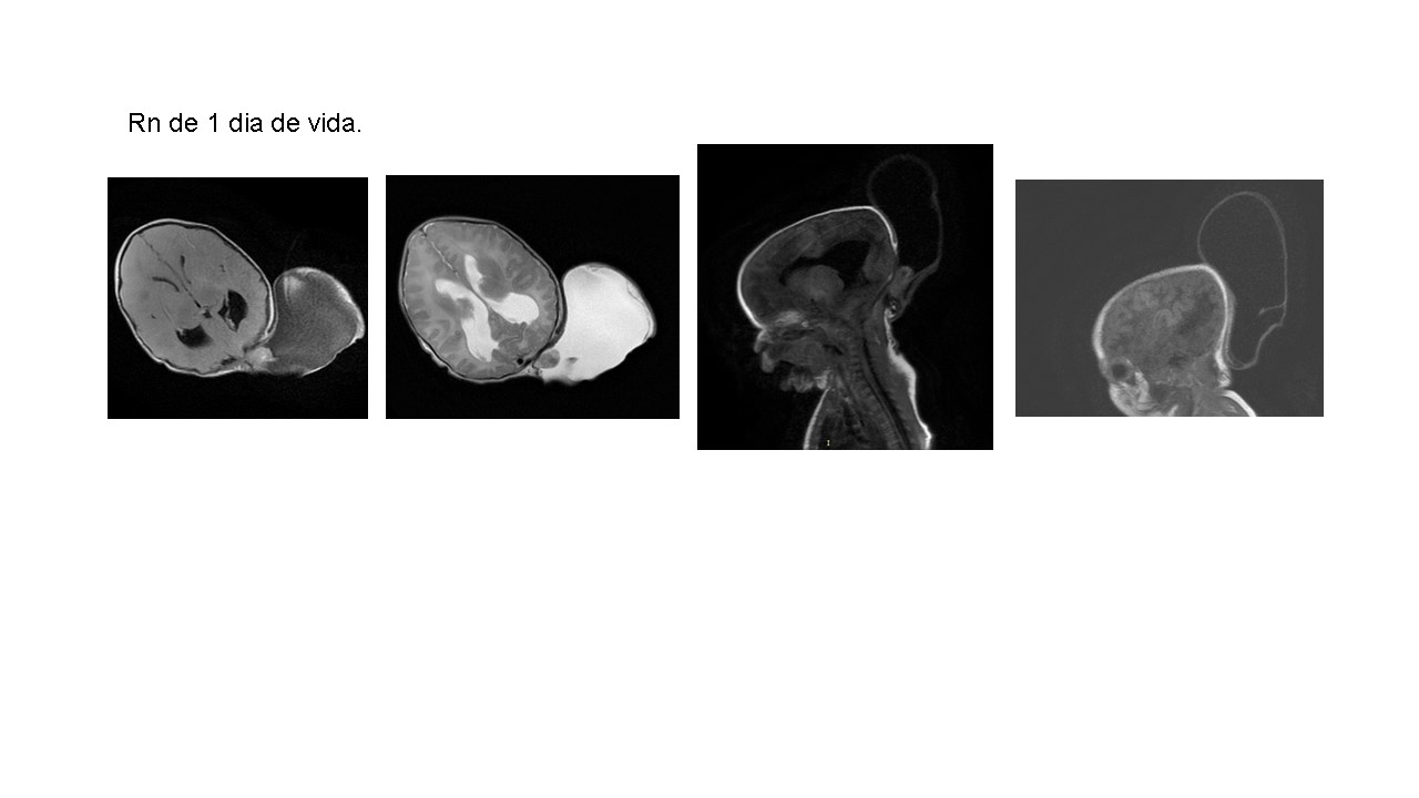 Meningocele Occipital