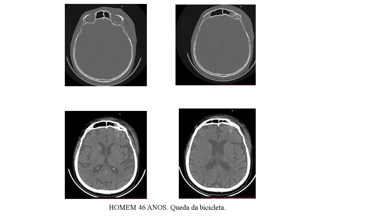 Trauma Frontal