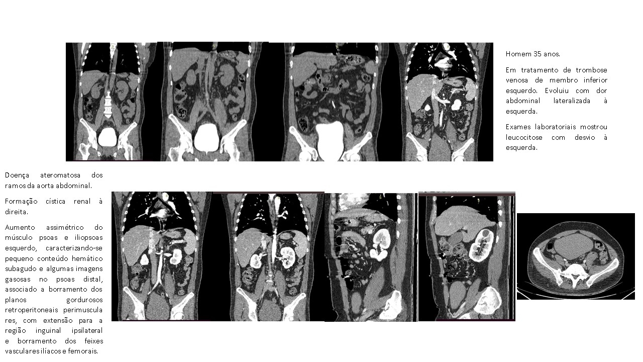 abscesso-psoas.jpg