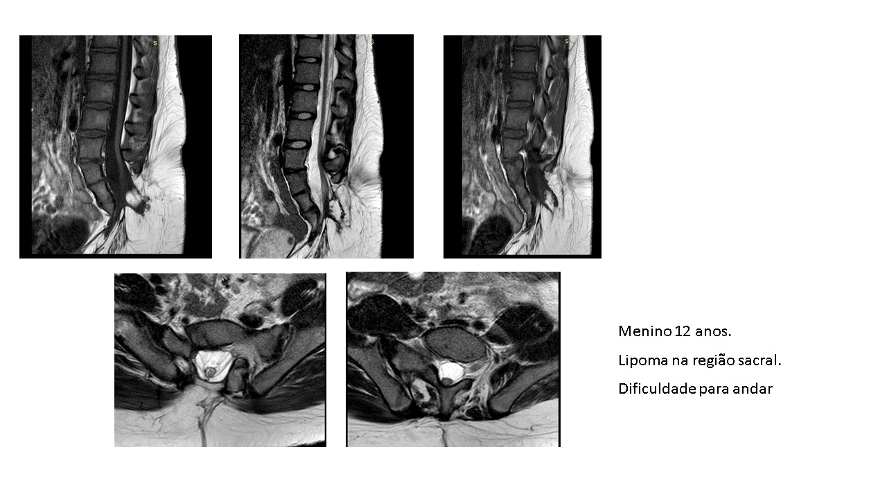 agenesia-sacral.jpg