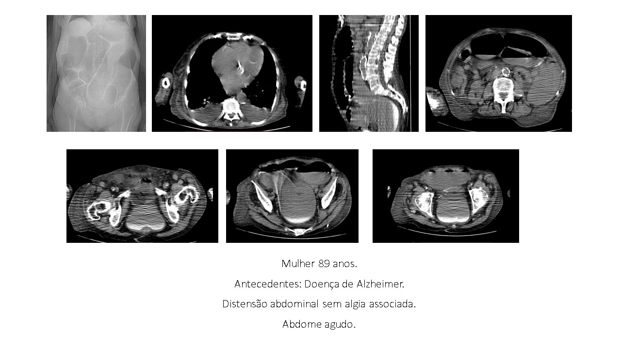 dsitensao-abdominal.jpg