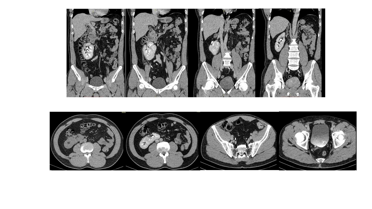 ectopia-renal.jpg