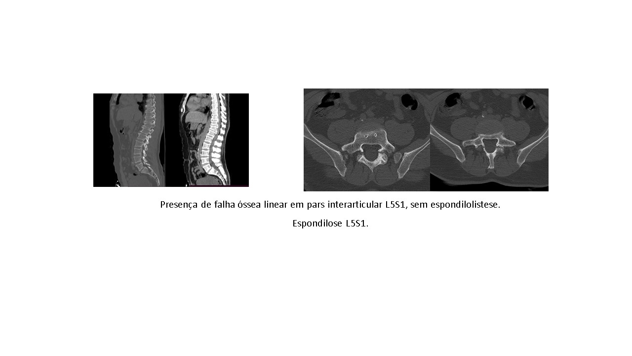 espondilolise-da-coluna-lombar.jpg