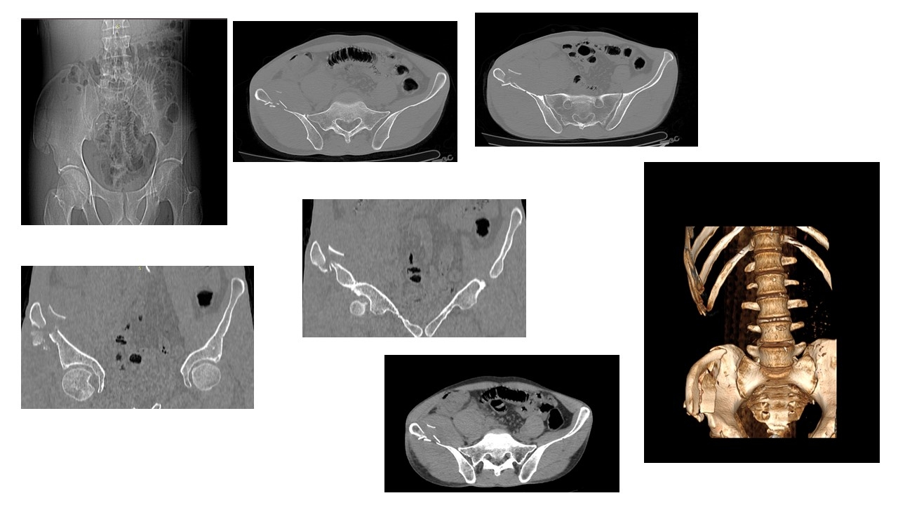 fratura-de-bacia.jpg