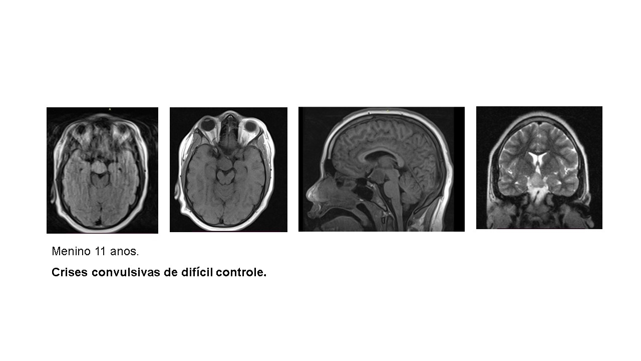 hamartoma-tuber-cinerio.jpg