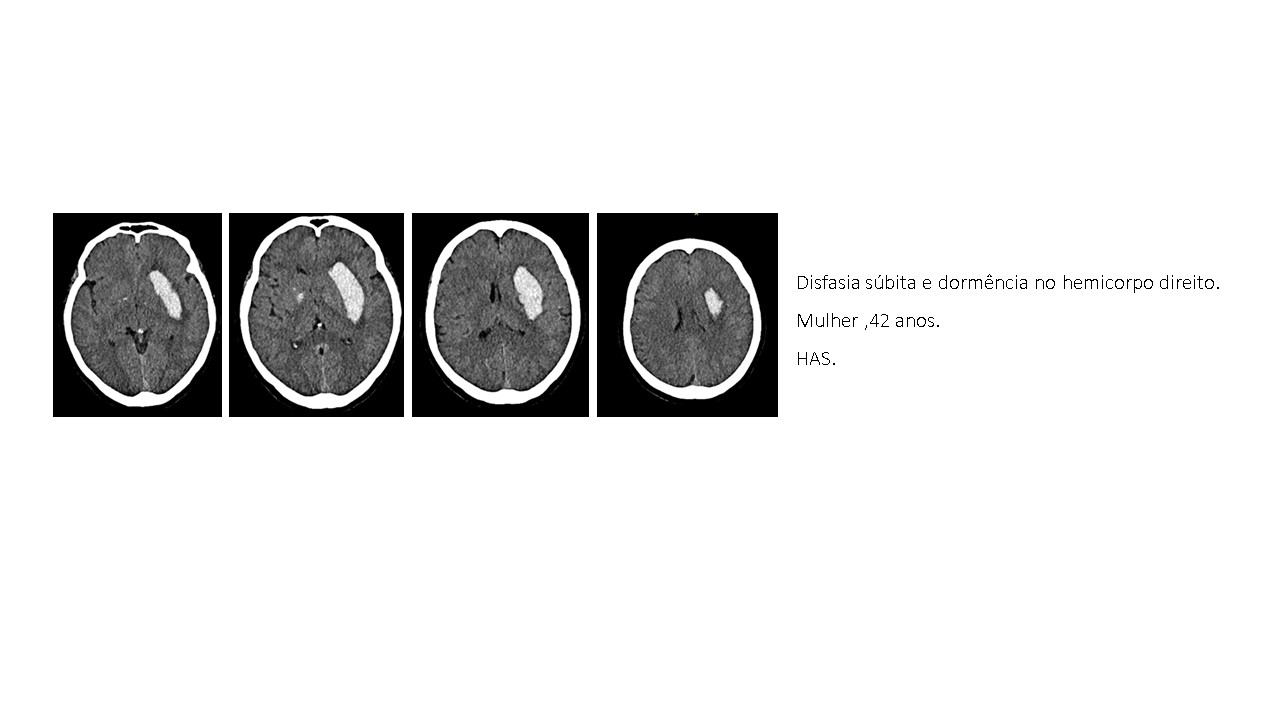 hematoma-ganglionico.jpg