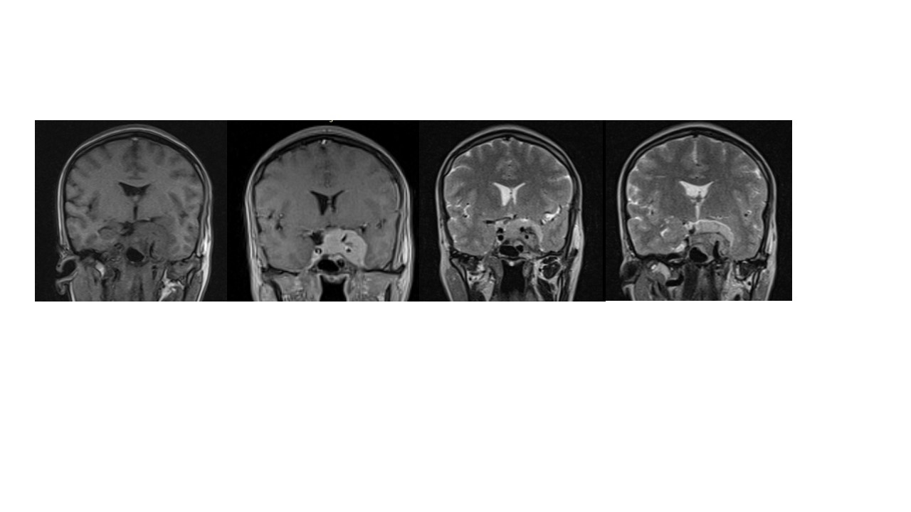 meningeoma-selar.jpg