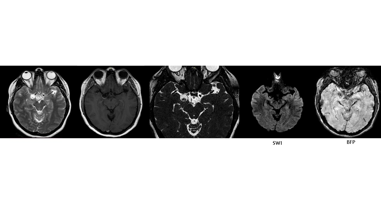 neurocisticercos.jpg