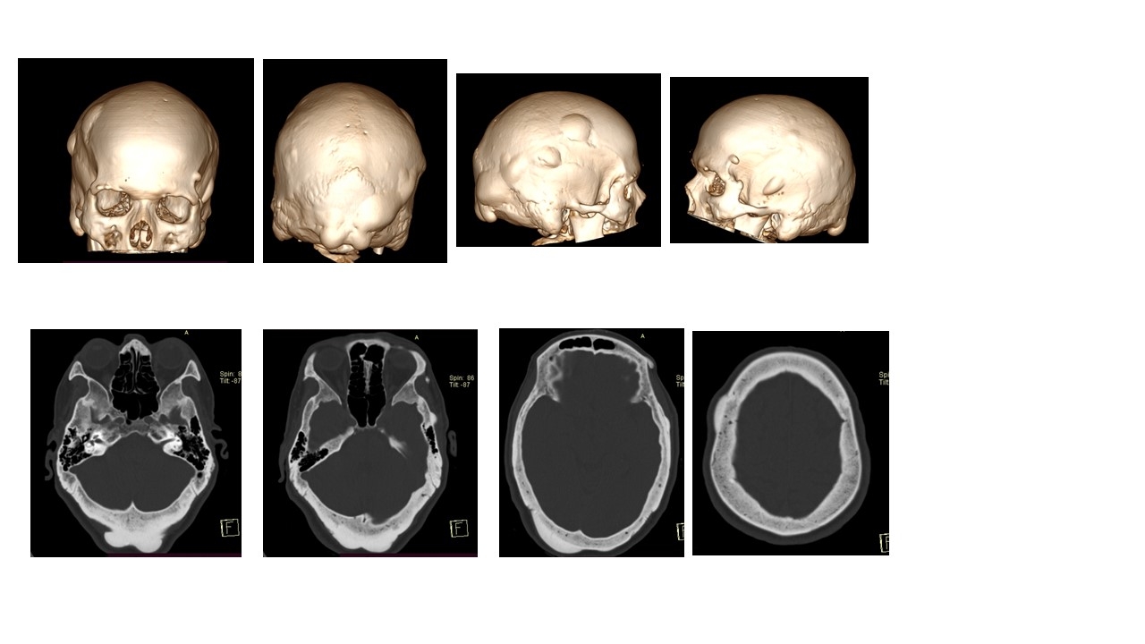 osteoma-calota-craniana.jpg