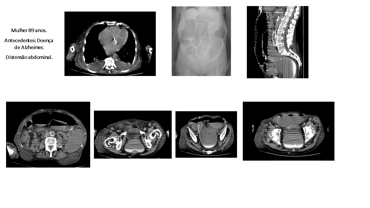 pseudo-ostrucao-intestinal.jpg