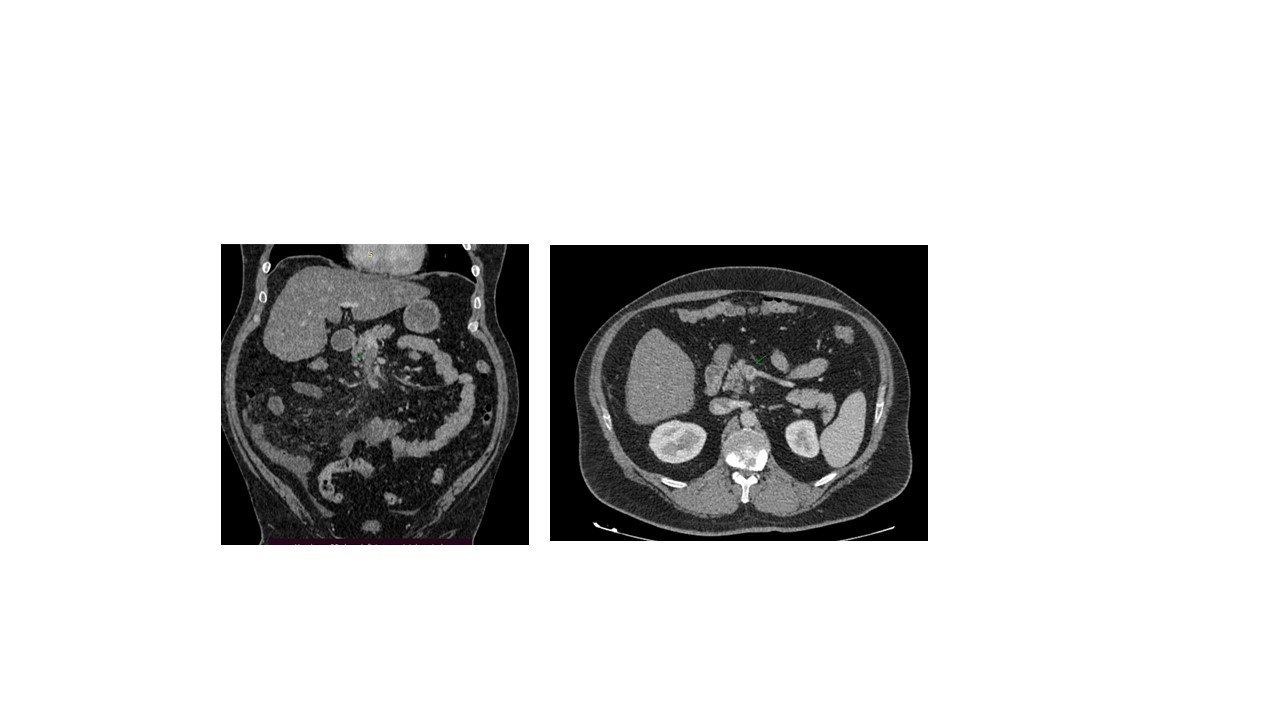 trombose-mesenterica-venosa-doc-4.jpg