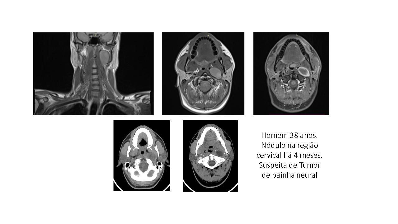 tumor-da-binha-neural.jpg