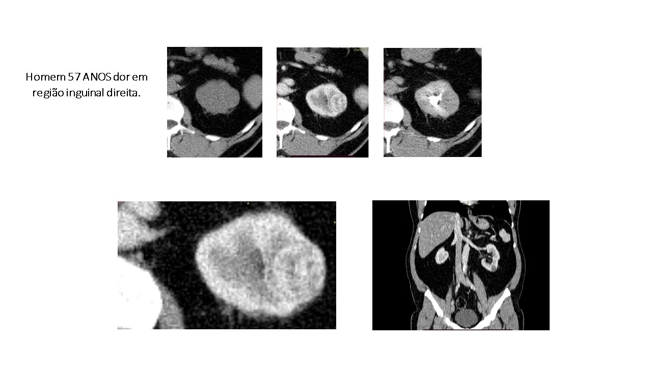 tumor-de-celulas-renais.jpg